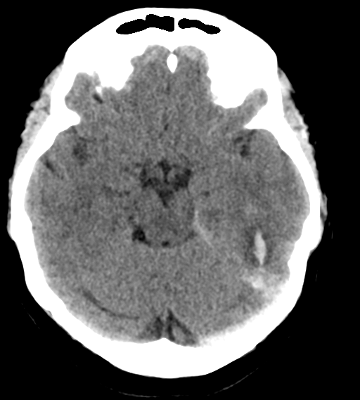 File:Cerebral venous infarction due to transverse sinus thrombosis (Radiopaedia 34688-36116 Axial non-contrast 10).png