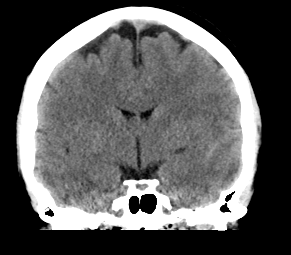File:Cerebral venous infarction due to transverse sinus thrombosis (Radiopaedia 34688-36116 Coronal non-contrast 18).png