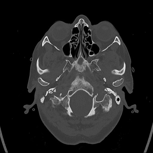 Cerebral venous infarction with hemorrhage (Radiopaedia 65343-74381 Axial bone window 6).jpg