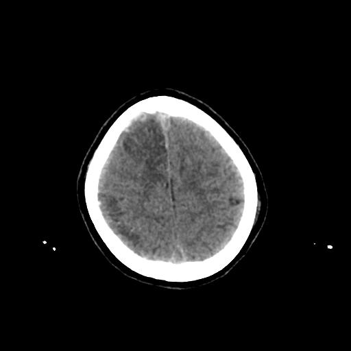 Cerebral venous throbmosis - hemorrhagic venous infarction (Radiopaedia 87318-103613 Axial non-contrast 147).jpg