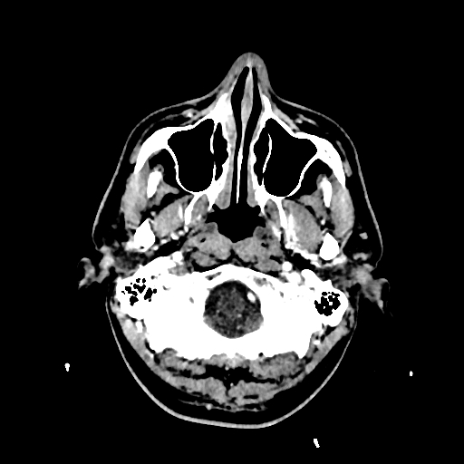 File:Cerebral venous thrombosis (CVT) (Radiopaedia 77524-89685 Axial with contrast 4).jpg