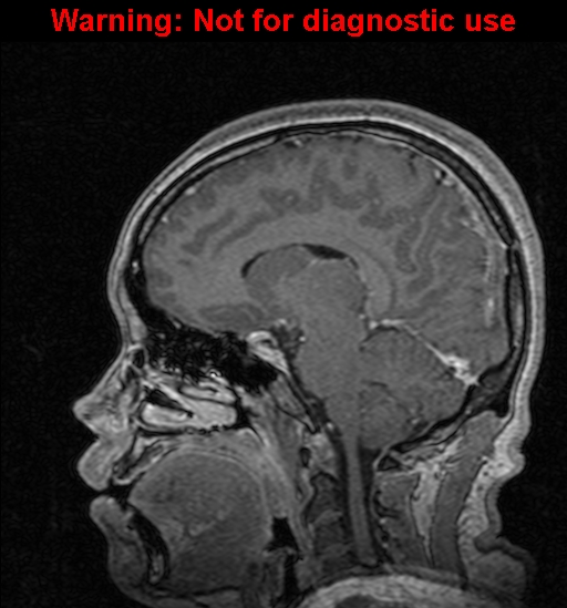 Cerebral venous thrombosis (Radiopaedia 37224-39208 Sagittal T1 C+ 85).jpg