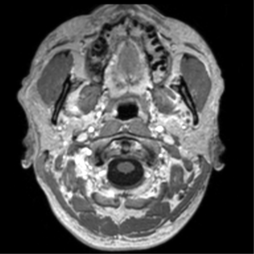 Cerebral venous thrombosis (Radiopaedia 38392-40469 Axial T1 C+ 5).png