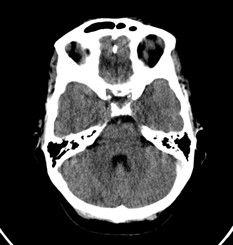 Cerebral venous thrombosis - CT only (Radiopaedia 41031-43778 Axial non-contrast 62).jpg