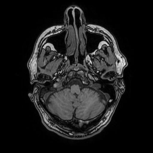 File:Cerebral venous thrombosis with secondary intracranial hypertension (Radiopaedia 89842-106957 Axial T1 45).jpg