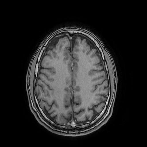 File:Cerebral venous thrombosis with secondary intracranial hypertension (Radiopaedia 89842-106957 Axial T1 C+ 125).jpg