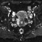 File:Cervical adenocarcinoma (Radiopaedia 65011-73985 Axial DWI 49).jpg