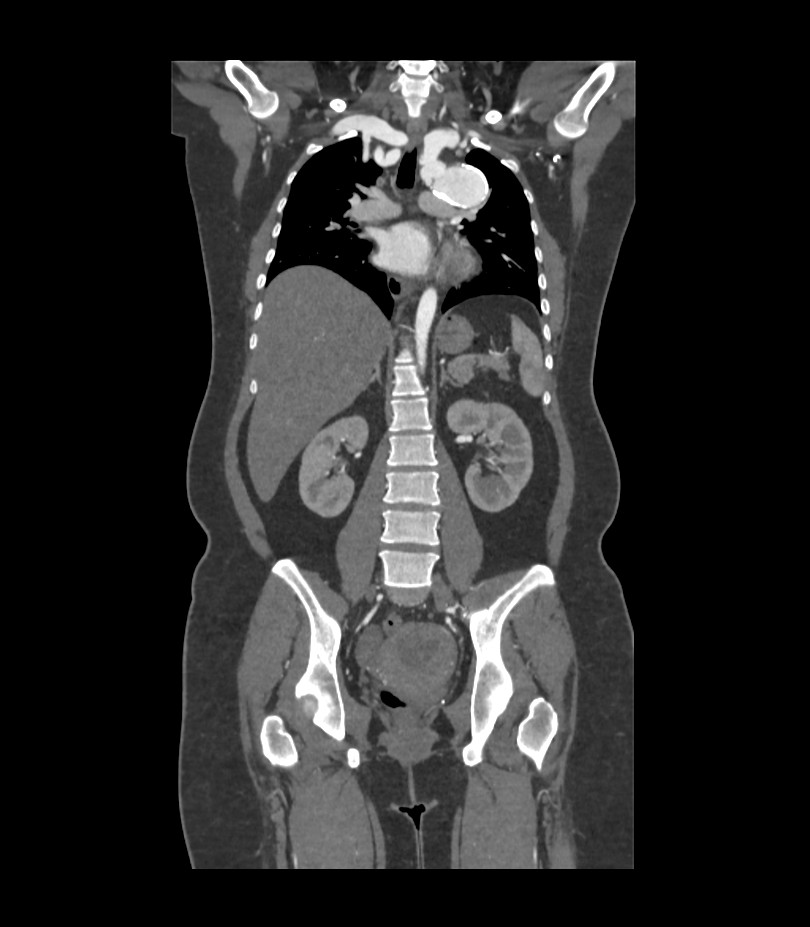 Cervical aortic arch with coarctation and aneurysms (Radiopaedia 44035-47552 C 20).jpg