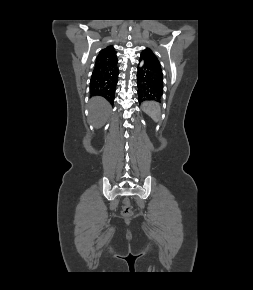 Cervical aortic arch with coarctation and aneurysms (Radiopaedia 44035-47552 C 8).jpg
