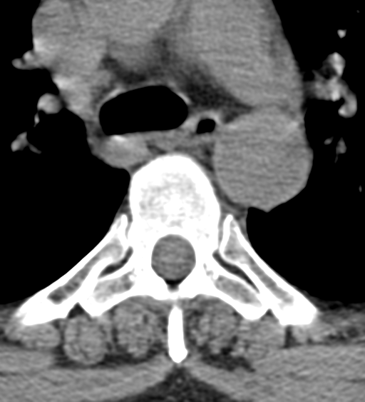 Cervical canal stenosis due to ossification of the posterior longitudinal ligament (Radiopaedia 47260-51823 Axial non-contrast 82).png
