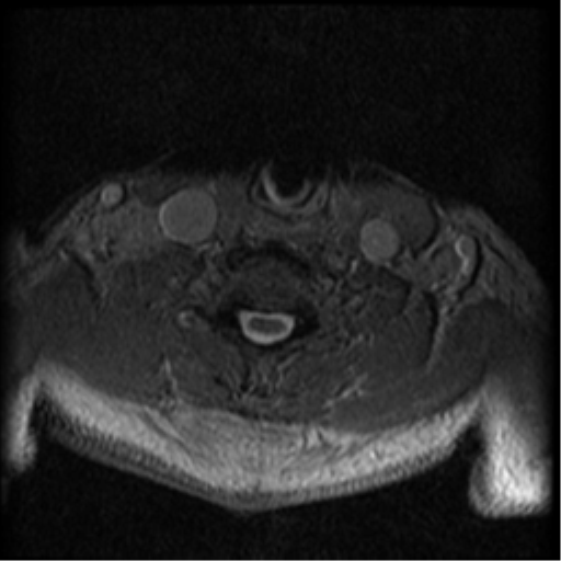 Cervical canal stenosis with cord compression (Radiopaedia 34114-35374 Axial Gradient Echo 28).png