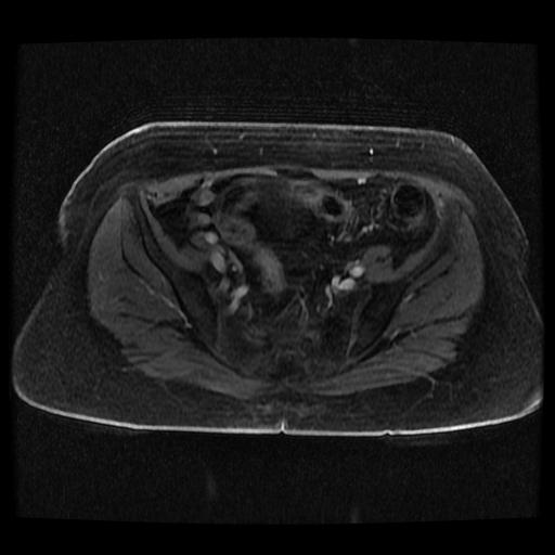 Cervical carcinoma (Radiopaedia 70924-81132 Axial T1 C+ fat sat 241).jpg