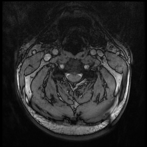 Cervical disc extrusion (Radiopaedia 59074-66364 G 28).jpg