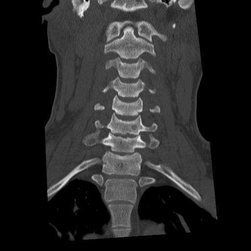 Cervical schwannoma (Radiopaedia 57979-64974 Coronal bone window 27).png