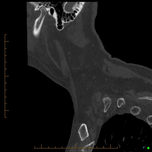 Cervical spine fracture - ankylosing spondylitis (Radiopaedia 76835-88706 Sagittal bone window 10).jpg