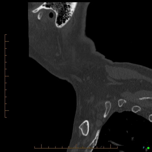 Cervical spine fracture - ankylosing spondylitis (Radiopaedia 76835-88706 Sagittal bone window 3).jpg