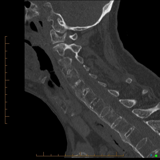 File:Cervical spine fracture - ankylosing spondylitis (Radiopaedia 76835-88706 Sagittal bone window 48).jpg