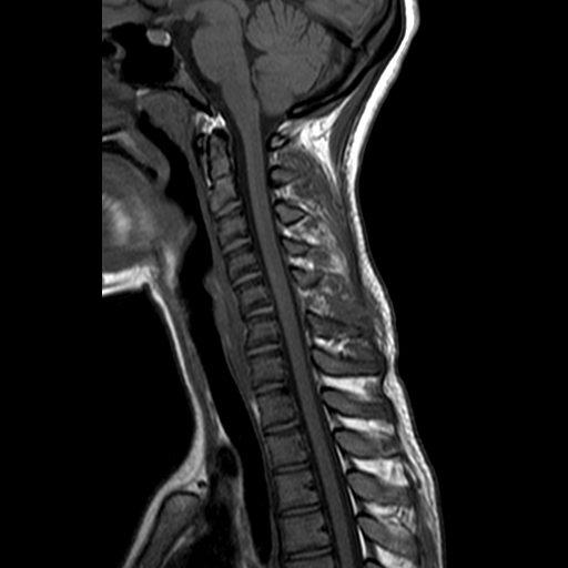 File:Cervical spine posterior ligamentous complex rupture (Radiopaedia 63486-72103 Sagittal T1 7).jpg