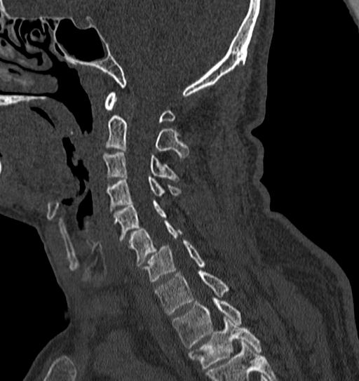 File:Cervical spine trauma with tear drop fracture and perched facet joint (Radiopaedia 53989-60127 Sagittal bone window 97).jpg