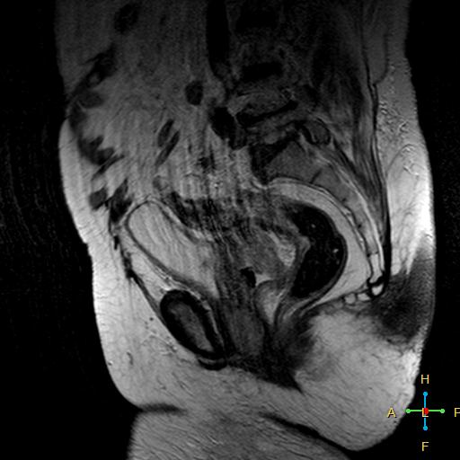 File:Cervical stump squamous cell carcinoma (Radiopaedia 48049-52858 Sagittal T2 8).jpg