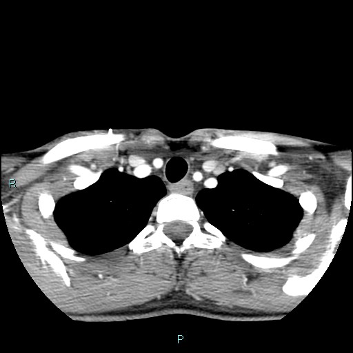 Cervical thymic cyst (Radiopaedia 88632-105335 B 25).jpg
