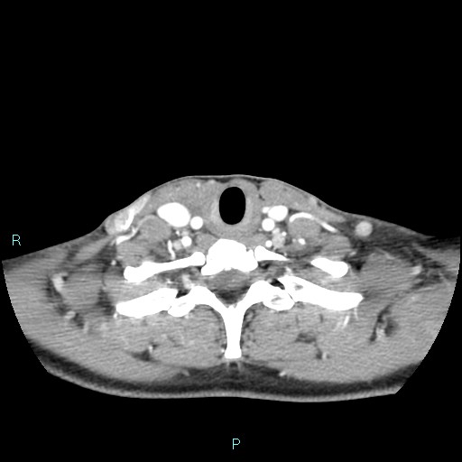 Cervical thymic cyst (Radiopaedia 88632-105335 B 37).jpg