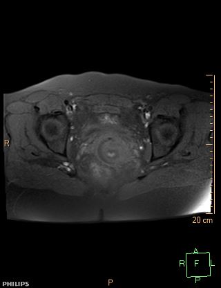 File:Cesarian scar endometriosis (Radiopaedia 68495-78066 Axial T1 fat sat 17).jpg