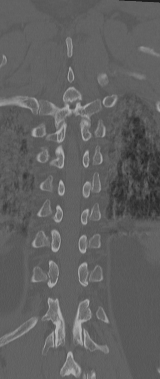 Chance fracture (Radiopaedia 33854-35020 Coronal bone window 64).png