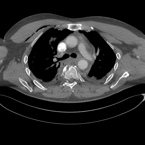 File:Chest multitrauma - aortic injury (Radiopaedia 34708-36147 A 116).png