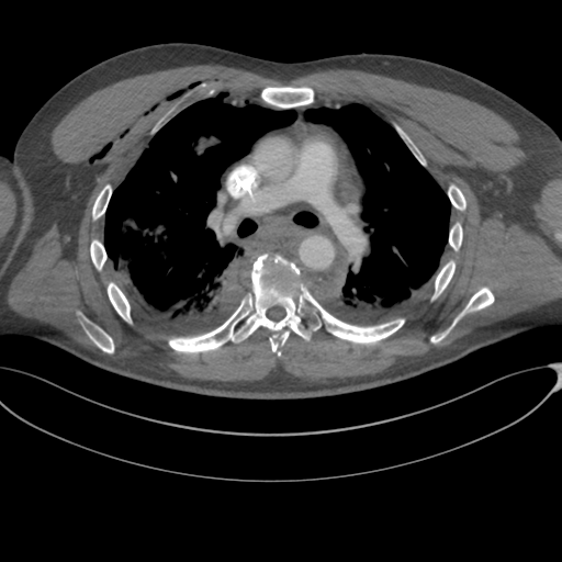 File:Chest multitrauma - aortic injury (Radiopaedia 34708-36147 A 130).png