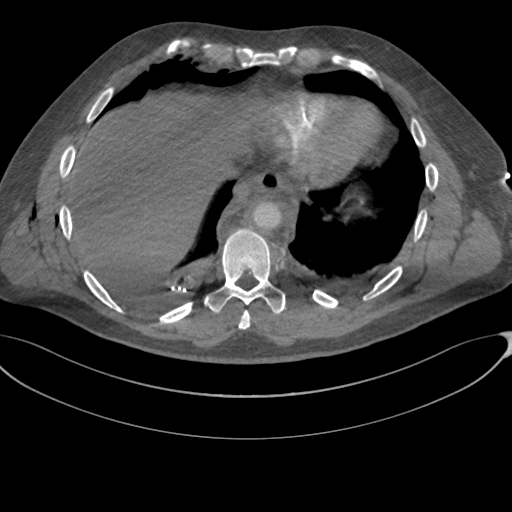 File:Chest multitrauma - aortic injury (Radiopaedia 34708-36147 A 229).png