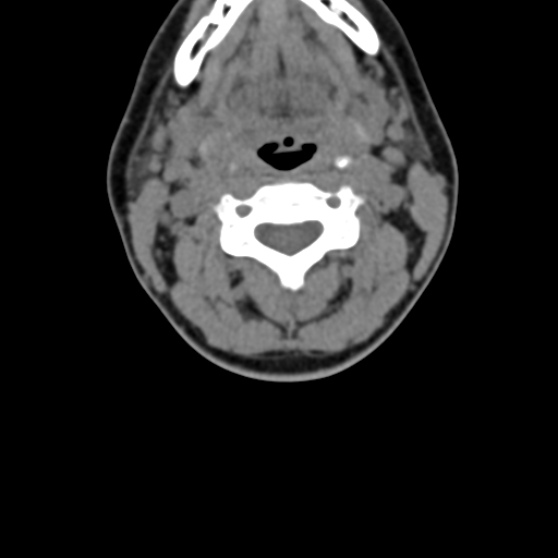 Chiari I malformation and obstructive hydrocephalus (Radiopaedia 41185-43981 D 46).png