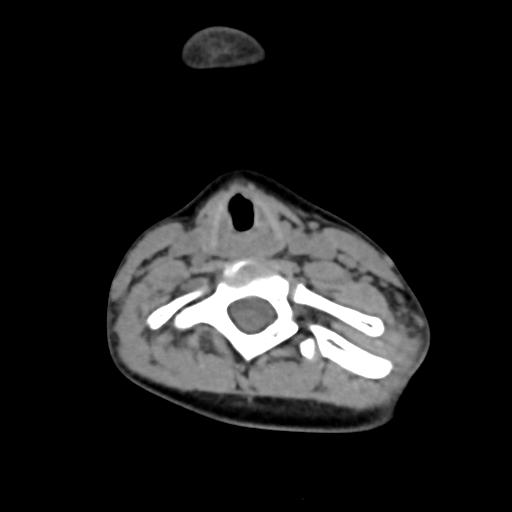 Chiari I with syrinx and skull base anomalies (Radiopaedia 89444-106412 Axial non-contrast 105).jpg