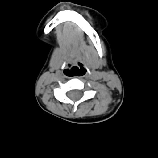 Chiari I with syrinx and skull base anomalies (Radiopaedia 89444-106412 Axial non-contrast 84).jpg