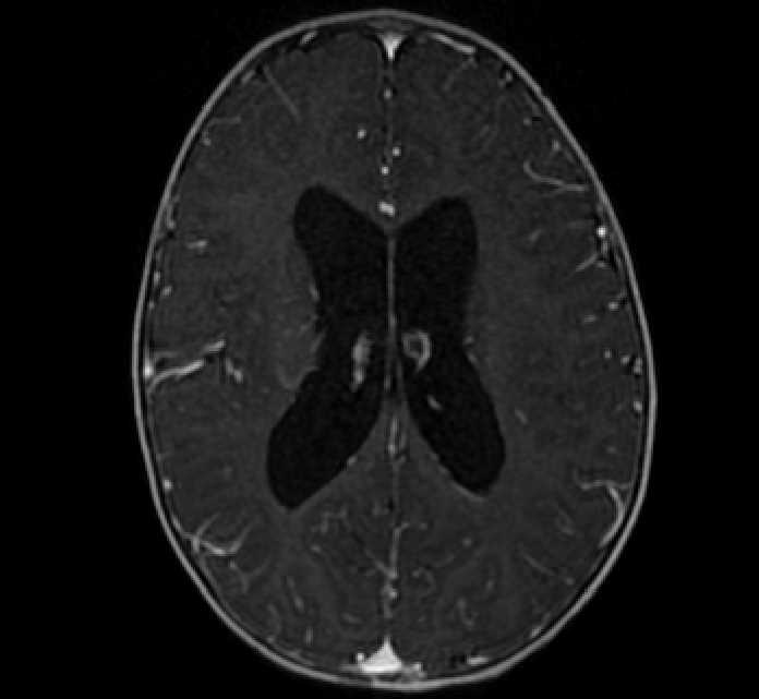 Chiasmatic-hypothalamic glioma (Radiopaedia 90079-107252 Axial T1 C+ 55).jpg
