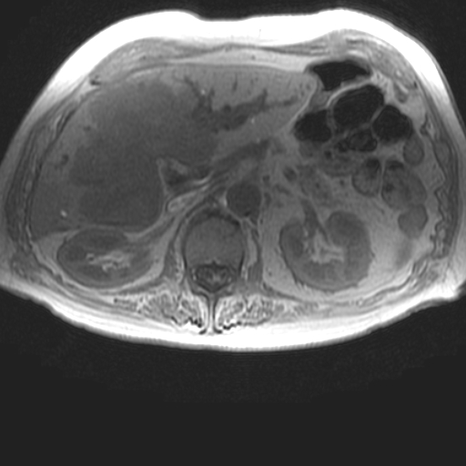 File:Cholangiocarcinoma - mass-forming pattern (Radiopaedia 16017-15677 T1 in-phase 15).jpg