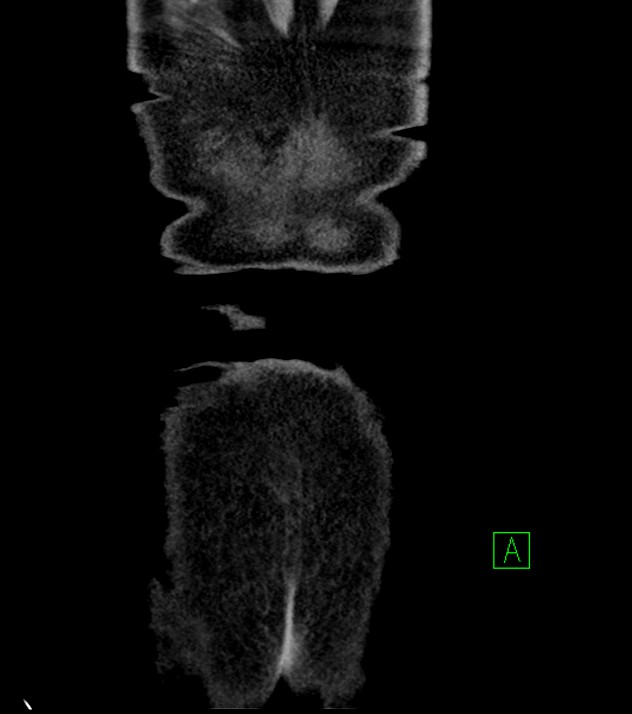 Cholangiocarcinoma with cerebral metastases (Radiopaedia 83519-98629 G 84).jpg