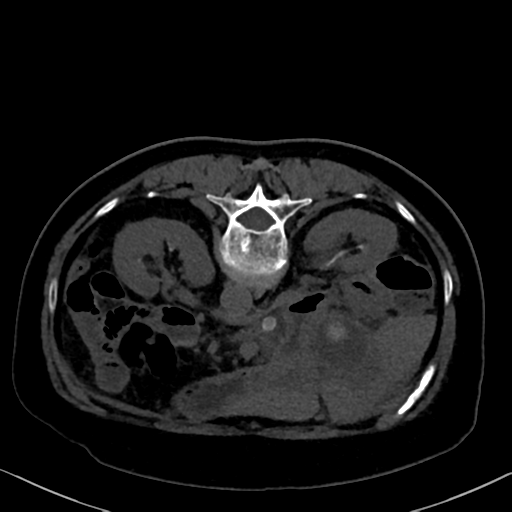 File:Cholecystitis - obstructive choledocholitiasis (CT intravenous cholangiography) (Radiopaedia 43966-47479 Axial 18).png