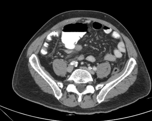 Cholecystitis - perforated gallbladder (Radiopaedia 57038-63916 A 58).jpg