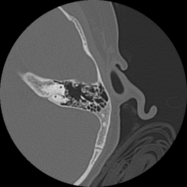 Cholesteatoma (Radiopaedia 73023-83750 Axial Left ear 60).jpg