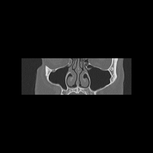 File:Cholesteatoma (Radiopaedia 84946-100455 Coronal bone window 35).jpg