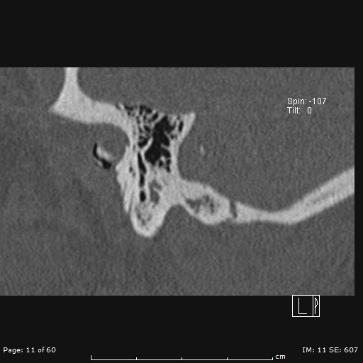 Cholesteatoma - external auditory canal (Radiopaedia 88452-105096 Sagittal bone window 11).jpg