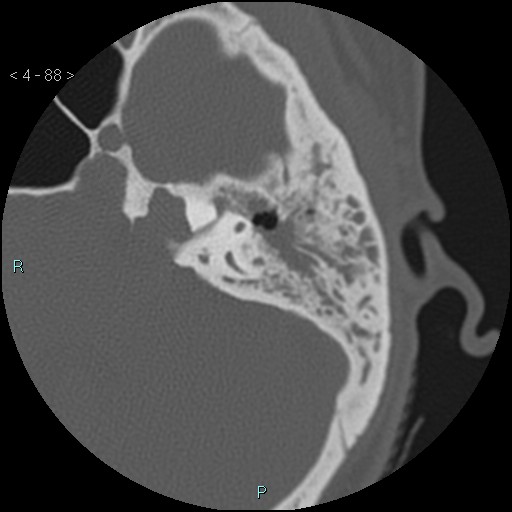 File:Cholesterol granuloma of the petrous apex (Radiopaedia 64358-73141 Axial bone window 43).jpg