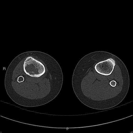Chondroblastoma (Radiopaedia 62721-71030 Axial bone window 90).jpg