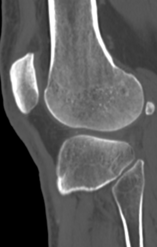 Chondrocalcinosis (Radiopaedia 82862-97173 Sagittal bone window 50).jpg