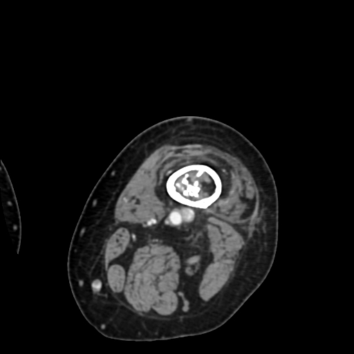 File:Chondrosarcoma - femur (Radiopaedia 64187-72954 Axial with contrast 11).jpg