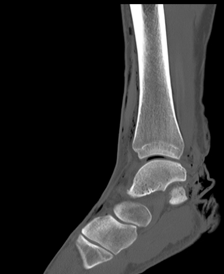 Chopart fracture (Radiopaedia 35347-36851 Sagittal bone window 27).jpg