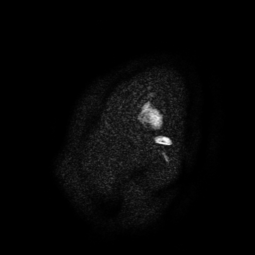 File:Chordoid glioma of third ventricle (Radiopaedia 91612-109340 F 4).jpg