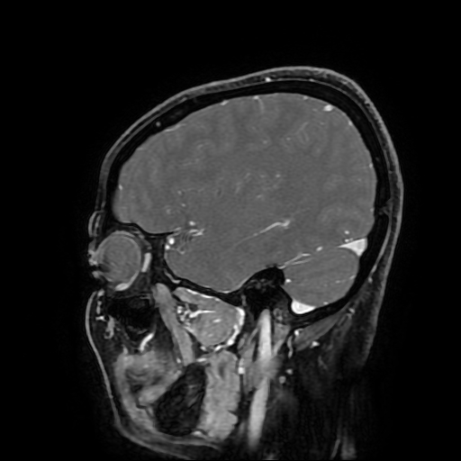 Chordoid glioma of third ventricle (Radiopaedia 91612-109340 F 61).jpg