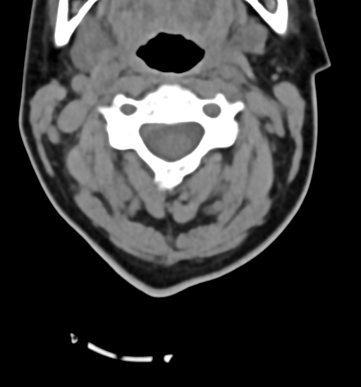 File:Chordoma (C4 vertebra) (Radiopaedia 47561-52188 Axial non-contrast 19).png
